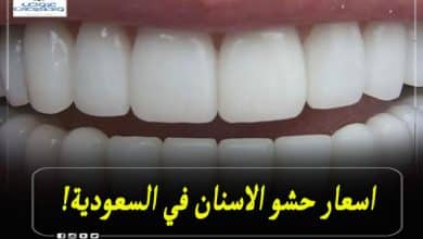 اسعار حشو الاسنان في السعودية